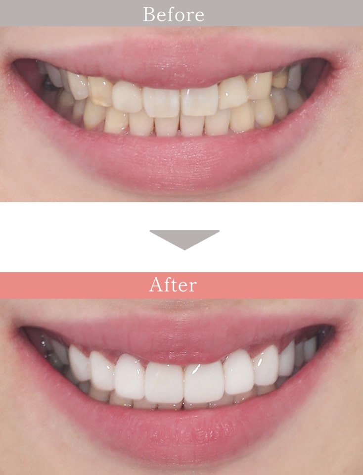 DDデンタルクリニックのラミネートベニアの症例