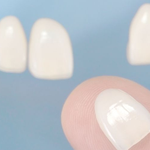 ラミネートベニアとは？費用相場・寿命・後悔しないための全知識