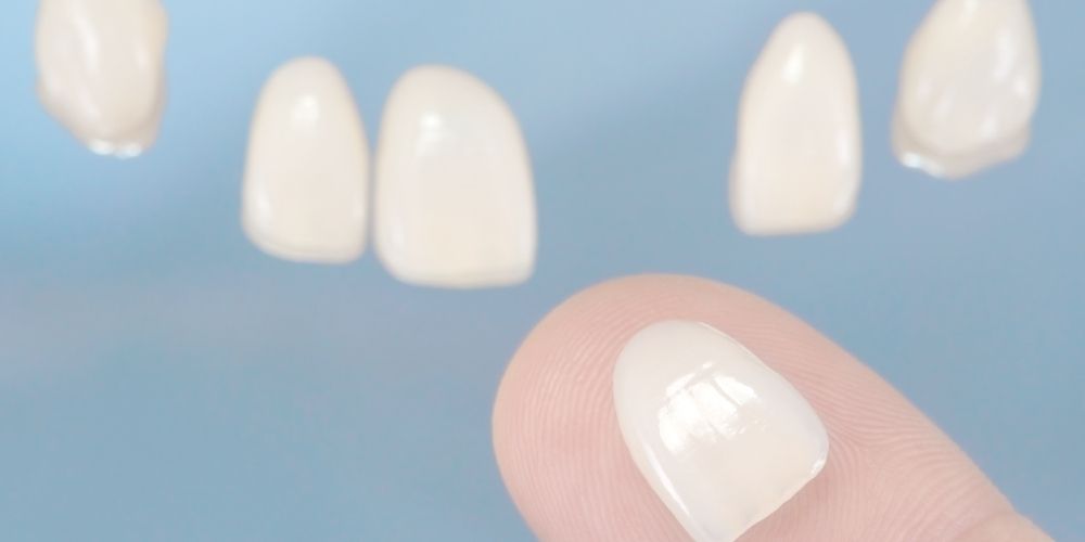 ラミネートベニアとは？費用相場・寿命・後悔しないための全知識