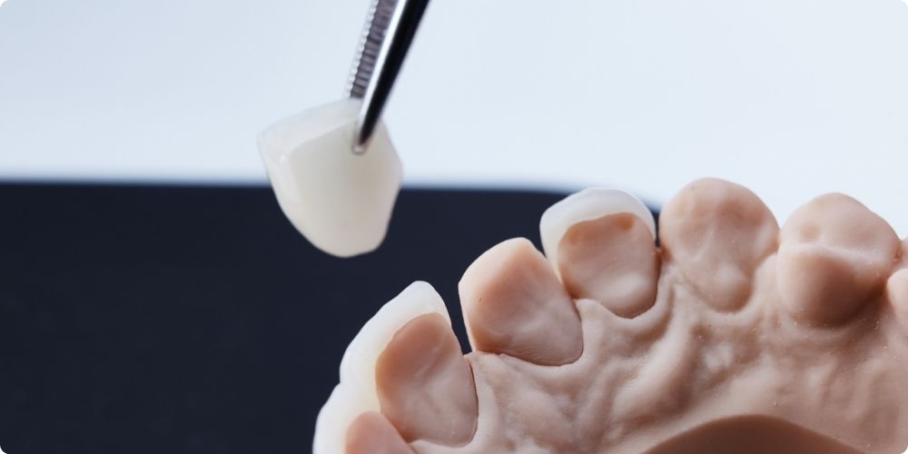 ラミネートベニアとはどんな治療？