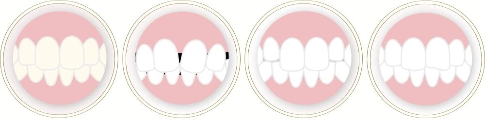 ラミネートベニアで対応できるおもな症例や悩み