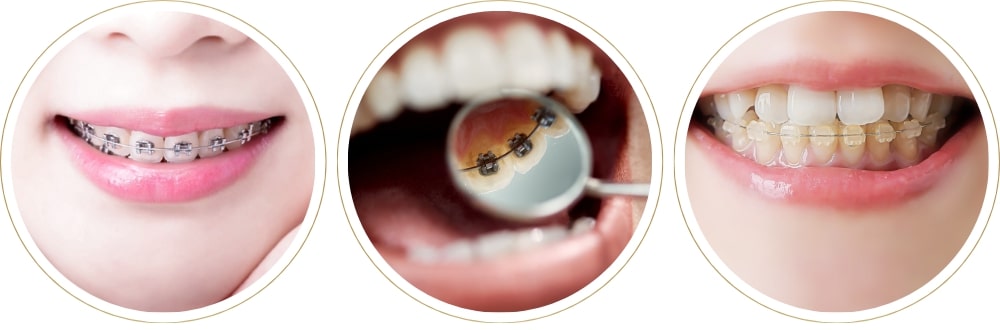 ワイヤー矯正の種類（表側矯正・裏側矯正・ハーフリンガル）