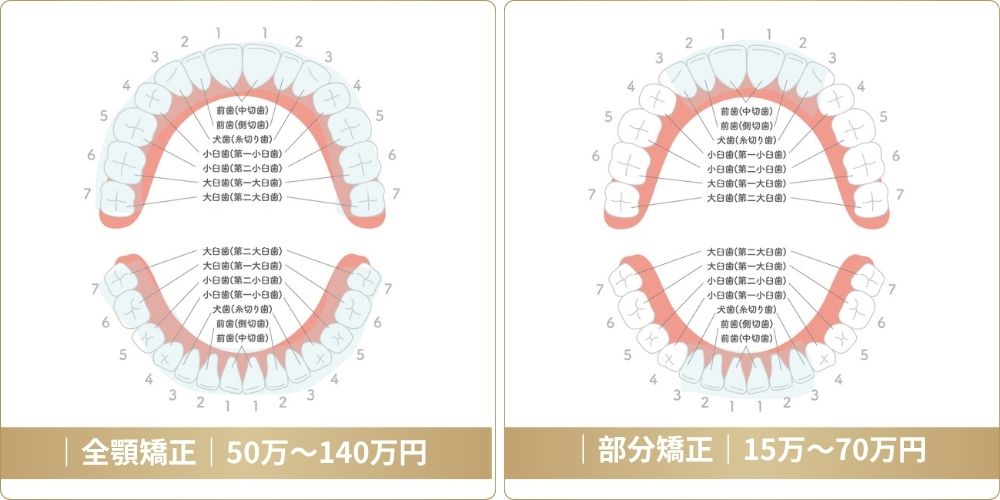 全顎矯正と部分矯正で大きく異なる平均の費用相場