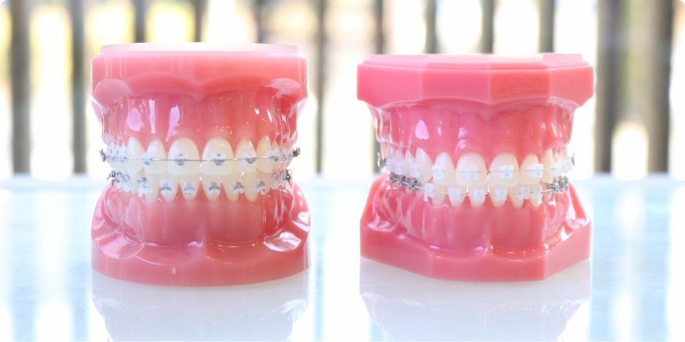 ワイヤー矯正の値段相場を理解して自分に合ったクリニックを探そう