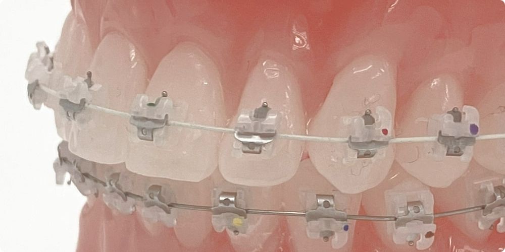京都四条矯正歯科クリニックの審美ワイヤー矯正