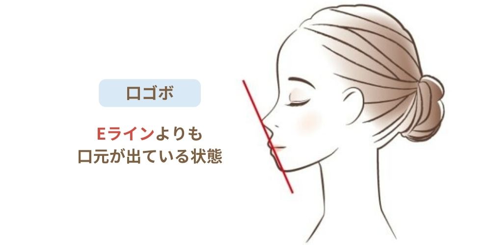そもそも「口ゴボ」とは？原因と見た目の特徴