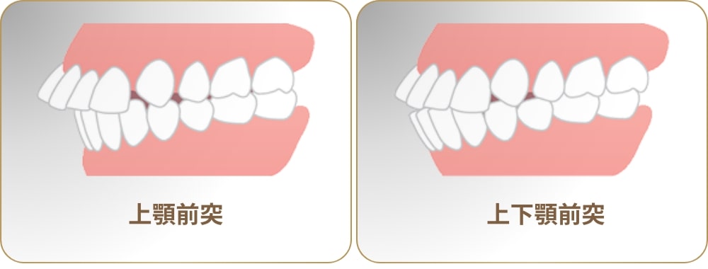 ブラーバ矯正で改善が期待できるケース