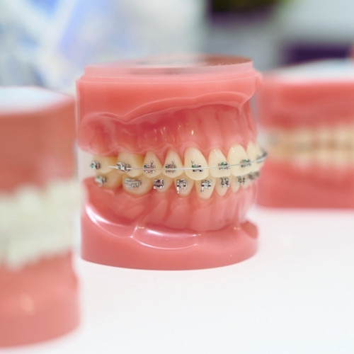 ワイヤー矯正とは│特徴・種類・仕組み・メリットを解説