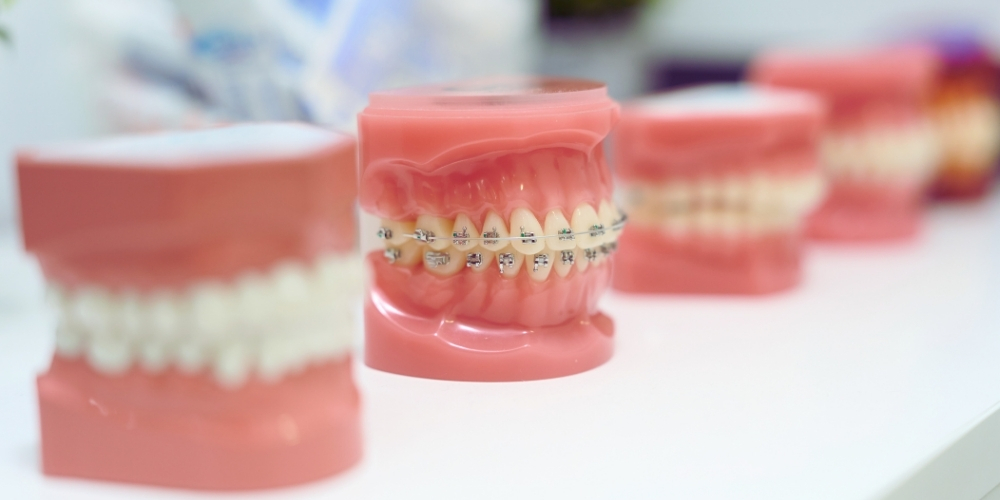 ワイヤー矯正とは│特徴・種類・仕組み・メリットを解説