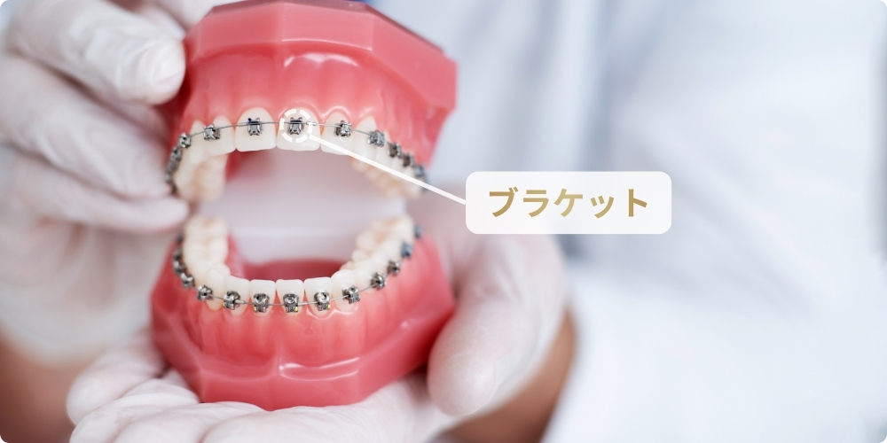 ワイヤー矯正とは？