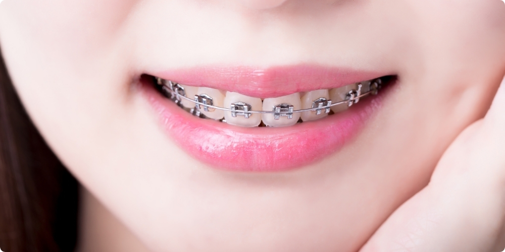 ワイヤー矯正の種類｜表側矯正（唇側矯正））