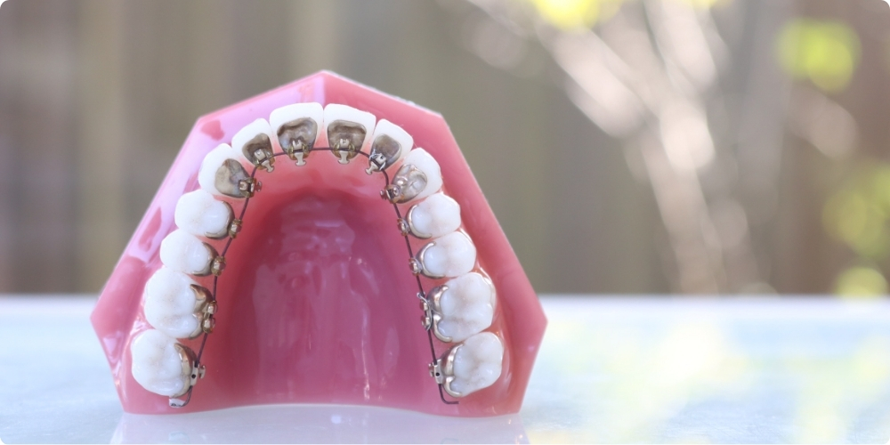 ワイヤー矯正の種類｜裏側矯正（舌側矯正・リンガル矯正）