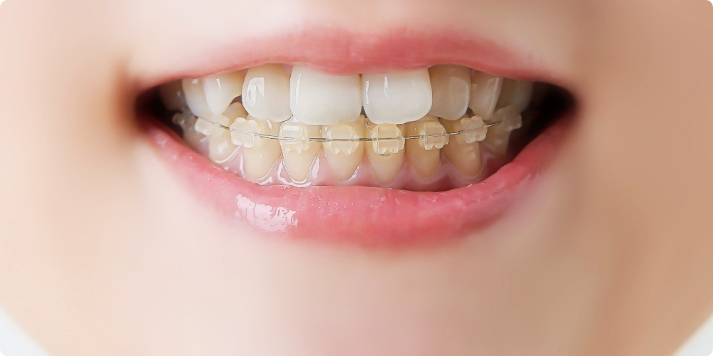 ワイヤー矯正の種類｜ハーフリンガル矯正