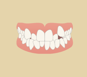 ガタガタ・八重歯