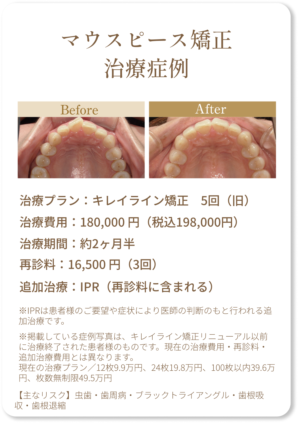 マウスピース矯正症例1