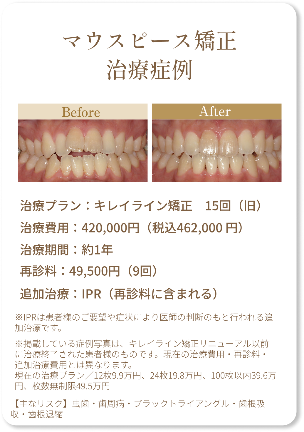 マウスピース矯正症例2