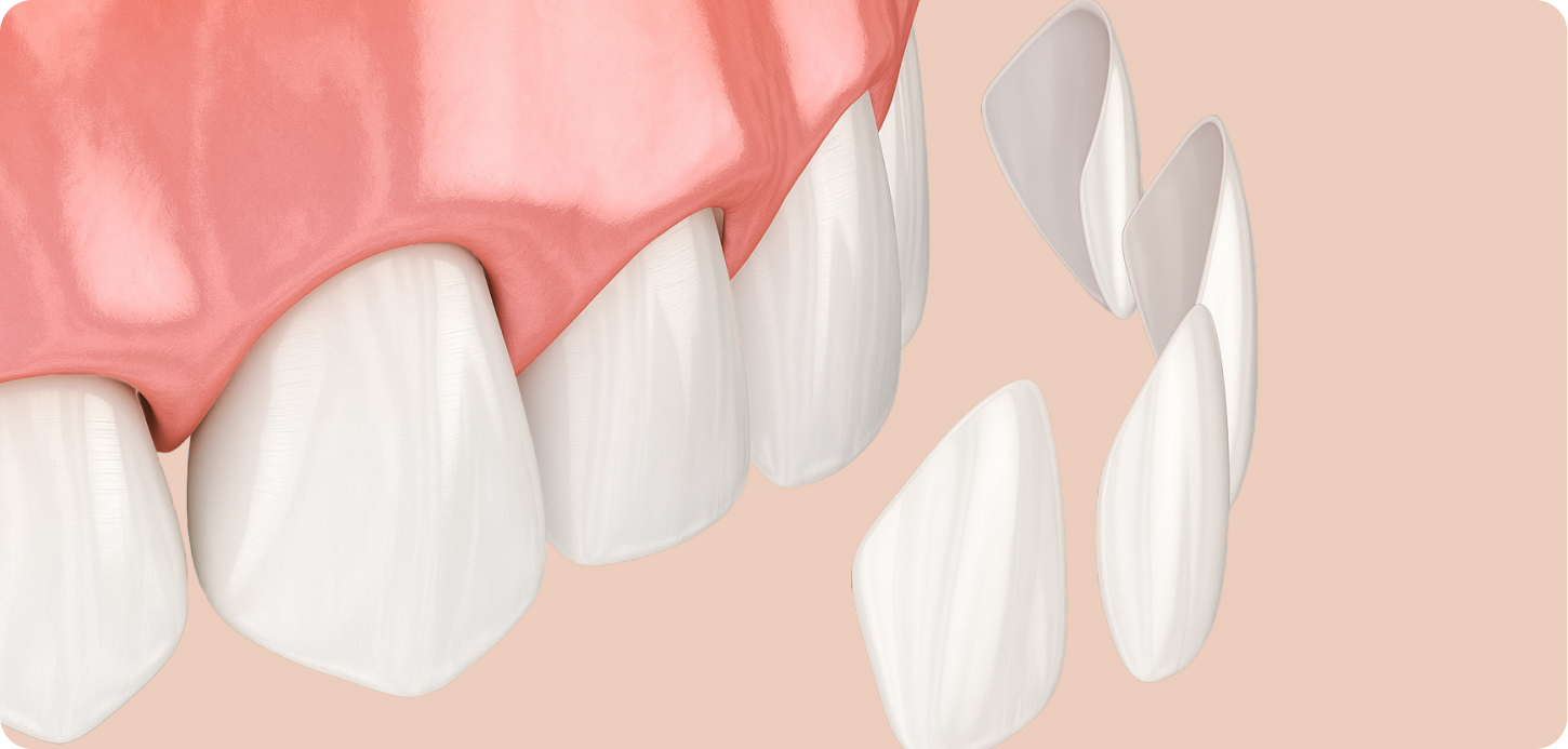 ラミネートべニアとは