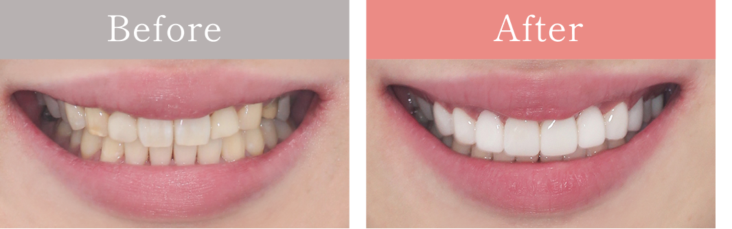 わずかに削り自然に美しく