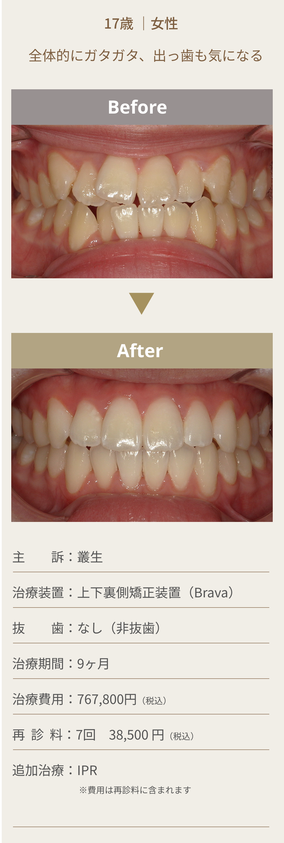 舌側矯正（裏側矯正）の症例1