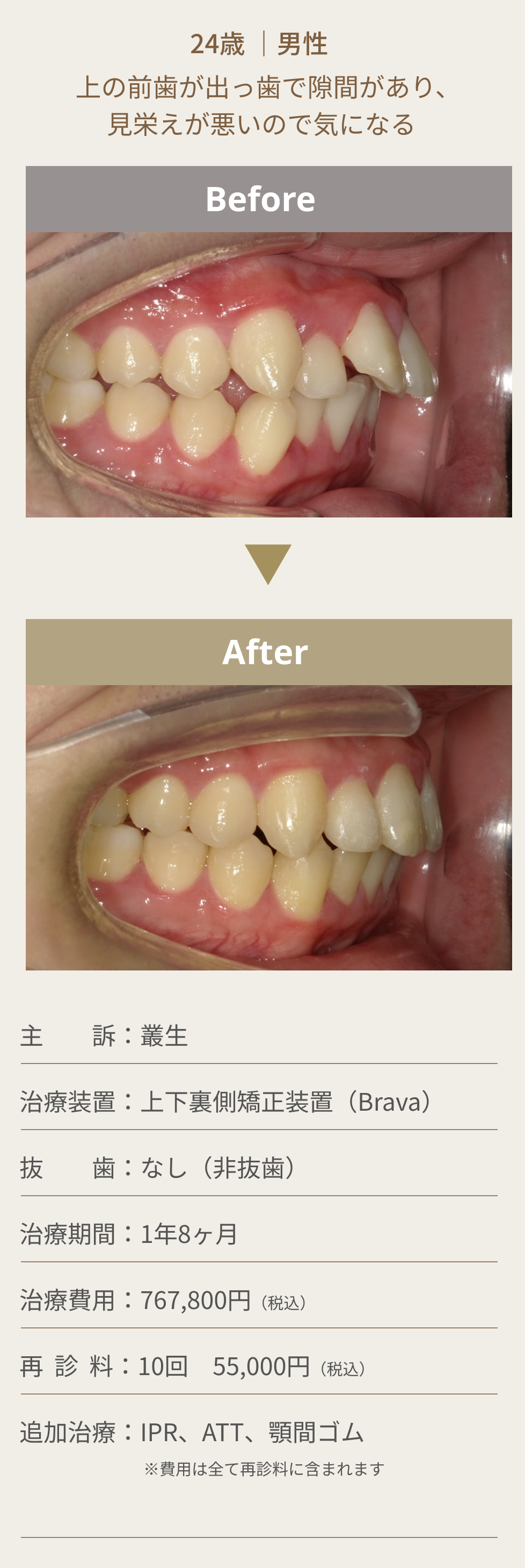 舌側矯正（裏側矯正）の症例2