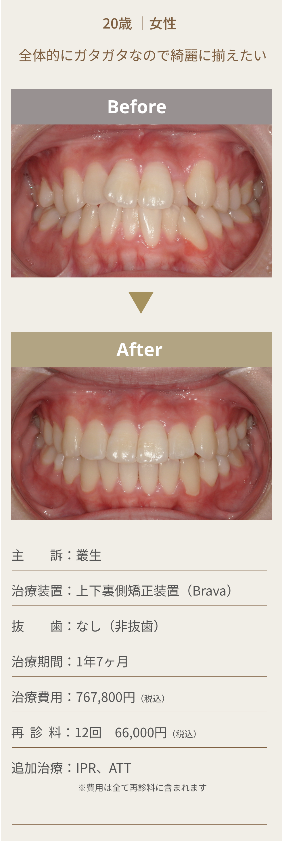 舌側矯正（裏側矯正）の症例3