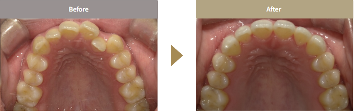 裏側矯正（ブラーバ矯正）で治療した患者様の症例（Before/After）