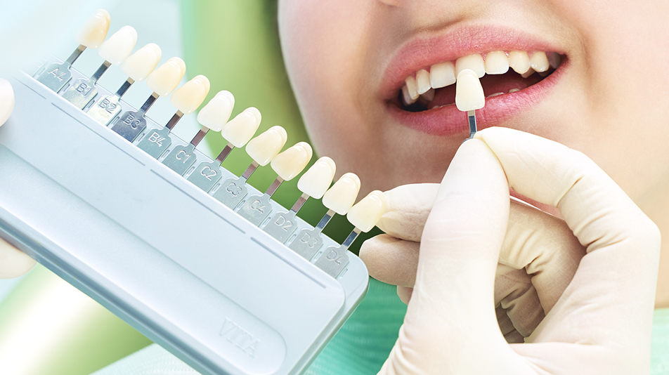 オフィスホワイトニング