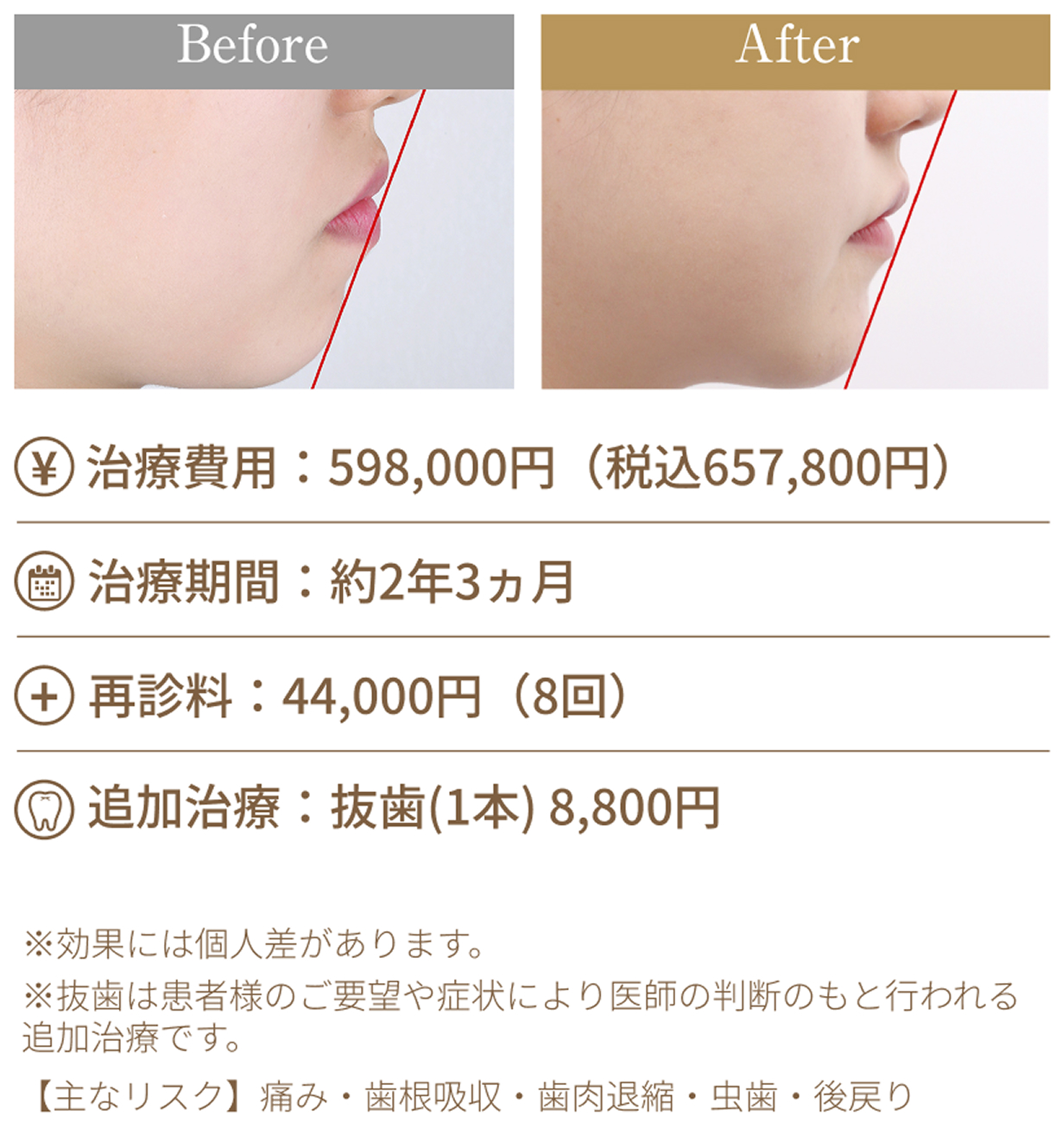 口ゴボ・Eラインの改善を目指す審美ワイヤー矯正