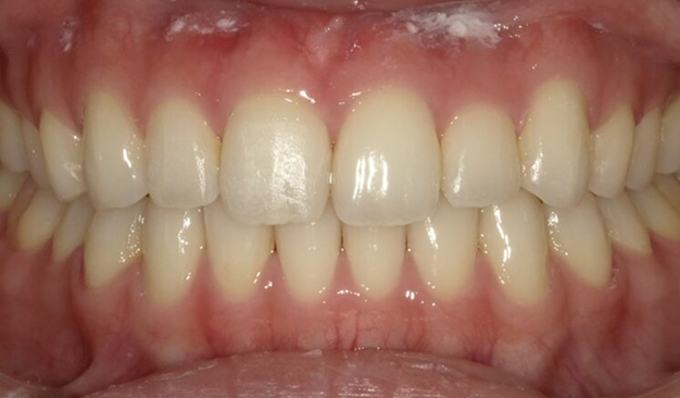 ブラーバ矯正の症例1000