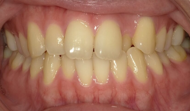 出っ歯や八重歯、奥歯が気になりブラーバ矯正で全顎矯正した症例​