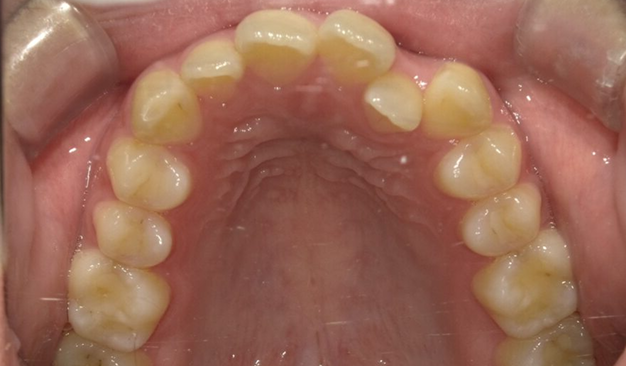 ブラーバ矯正の症例1000