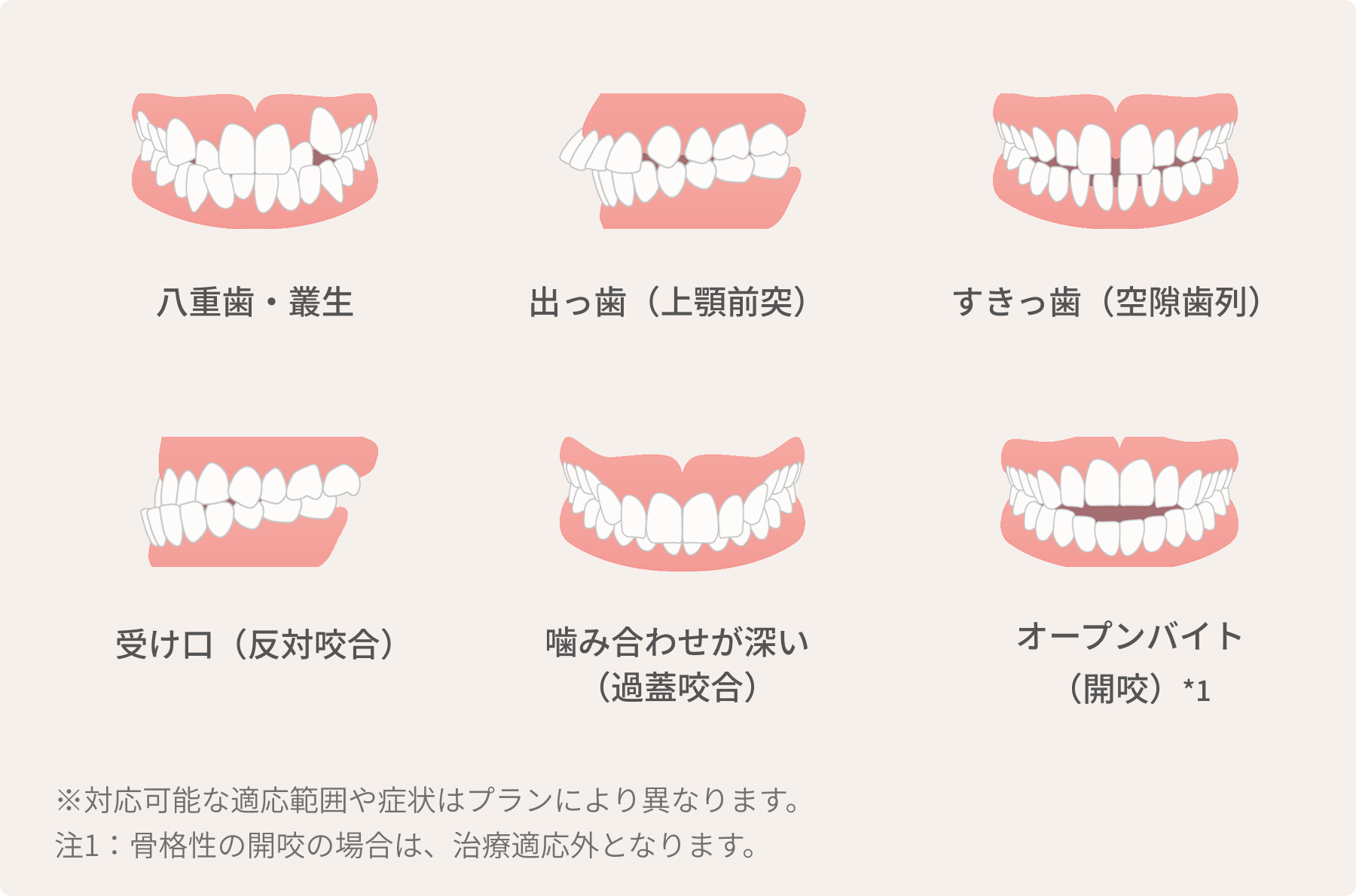 前歯の軽度な歯並び症状から重度まで症状に合ったプランが選べる<br />

