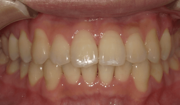 裏側矯正ブラーバ矯正｜叢生（ガタガタ）の症例（治療前）