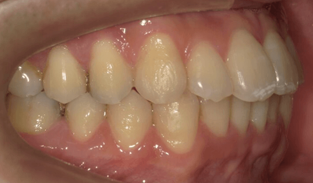 裏側矯正ブラーバ矯正｜叢生（ガタガタ）の症例（治療後）