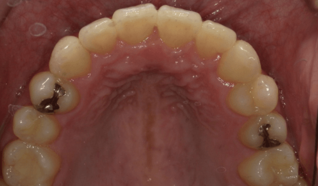 裏側矯正ブラーバ矯正｜叢生（ガタガタ）の症例（治療後）