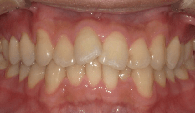 裏側矯正ブラーバ矯正｜叢生（ガタガタ）の症例（治療前）