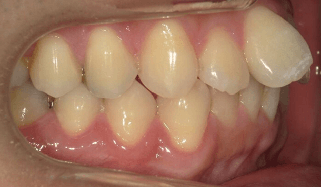 裏側矯正ブラーバ矯正｜叢生（ガタガタ）の症例（治療前）