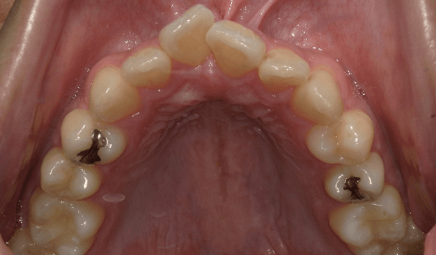 裏側矯正ブラーバ矯正｜叢生（ガタガタ）の症例（治療前）