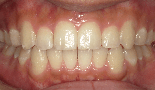 マウスピース矯正（インビザライン）｜叢生（ガタガタ）の症例（治療後）
