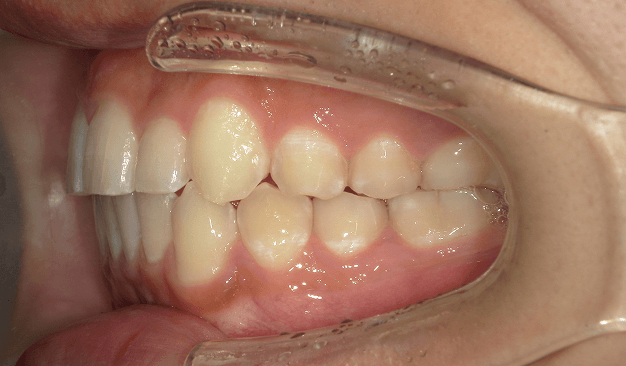 マウスピース矯正（インビザライン）｜叢生（ガタガタ）の症例（治療後）