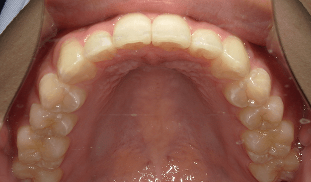 マウスピース矯正（インビザライン）｜叢生（ガタガタ）の症例（治療後）