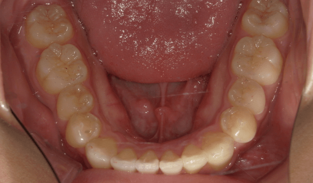 マウスピース矯正（インビザライン）｜叢生（ガタガタ）の症例（治療後）