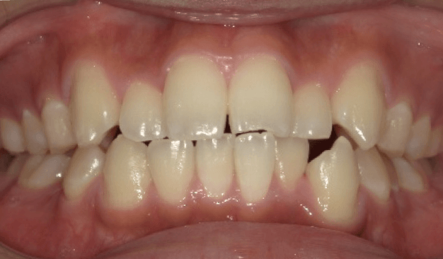 マウスピース矯正（インビザライン）｜叢生（ガタガタ）の症例（治療前）