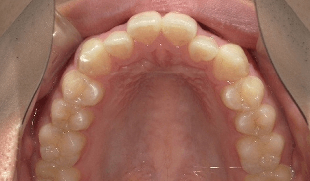 マウスピース矯正（インビザライン）｜叢生（ガタガタ）の症例（治療前）