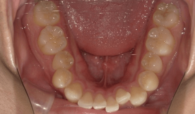 マウスピース矯正（インビザライン）｜叢生（ガタガタ）の症例（治療前）