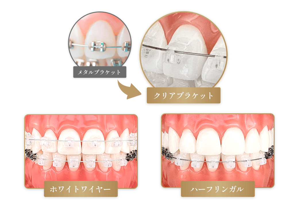 比較的目立ちにくいクリアブラケットを採用