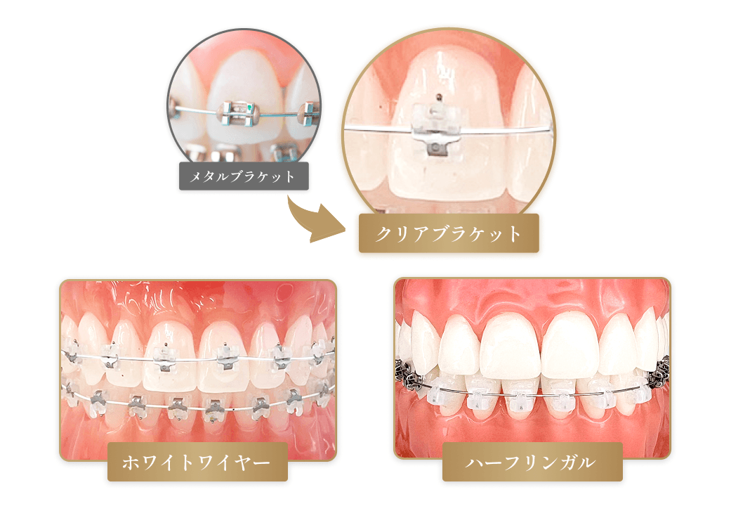 比較的目立ちにくいクリアブラケットを採用